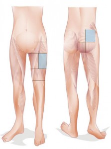 Where to inject steroids in leg diagram